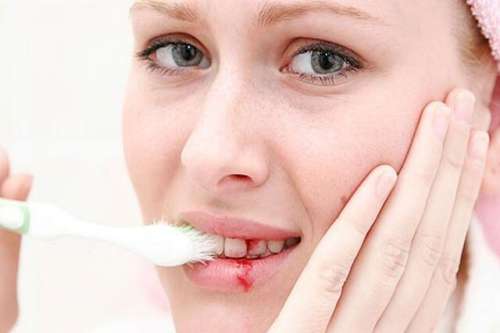 Lượng đường trong máu cao, gây ra tình trạng nướu gây sưng đỏ và dễ chảy máu khi đánh răng hoặc dùng chỉ nha khoa.